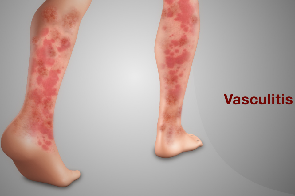 Vaskulitis